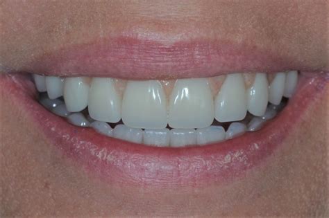 Impressive Dental Implant Before And Afters Ddi Dorset