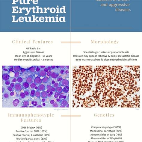 Pure Erythroid Leukemia Clinicopathologic Features Infographic