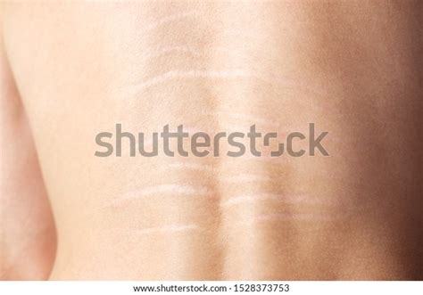 Close View Back Stretch Marks On Stock Photo 1528373753 Shutterstock