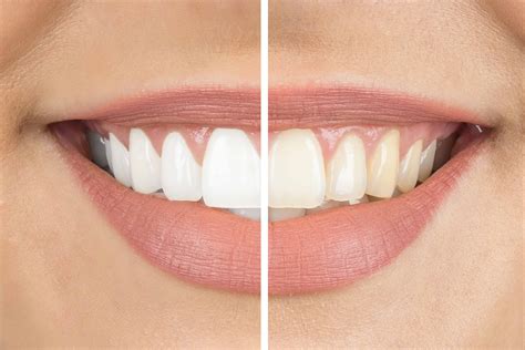 Considering Teeth Whitening Causes Of Tooth Discoloration