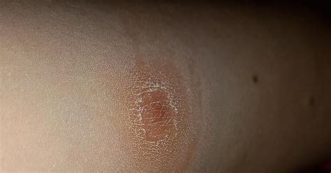 Skin Infection Album On Imgur