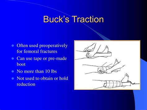 Alisourcepro makes it simple, with just a few steps: PPT - Orthopaedic Traction PowerPoint Presentation - ID:210938