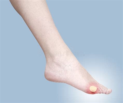 Healing Blister On The Foot Concept Photo With Color Enhanced S Stock