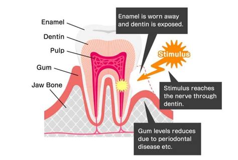 tooth sensitivity what you need to know and what you can do