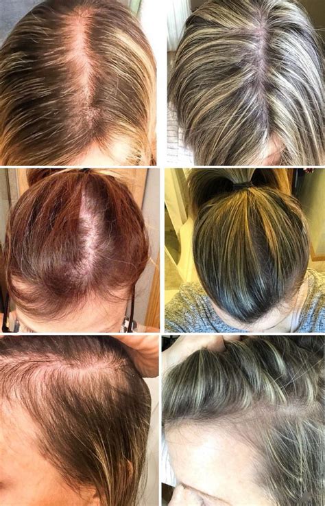 How Long Will Hair Fall Out After Pregnancy Best Simple Hairstyles