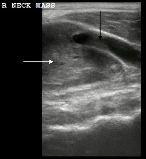 Cureus More Than A Lymph Node In The Neck A Rare Synovial Cell