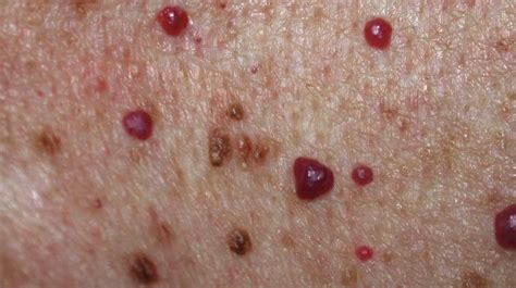 Raised Skin Bump 25 Causes Photos And Treatments Bacana