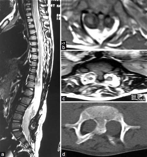 A D Sagittal Axial T1w Axial T2w Mri Images And Axial Ct Image Of A