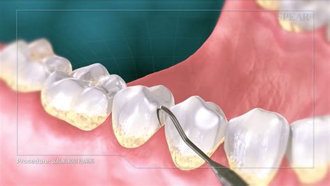 Non Surgical Periodontal Therapy Scaling And Root Planing Chapel