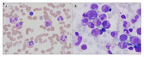 Morphology In A Patient Of Chronic Eosinophilic Leukemia With A