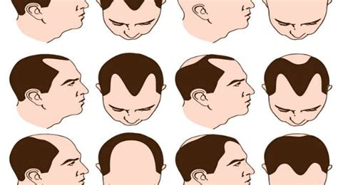 What Every Man Ought To Know About Treatment For Alopecia Areata What Do