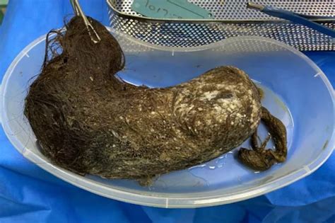 hairball removed from stomach of teen with rapunzel syndrome