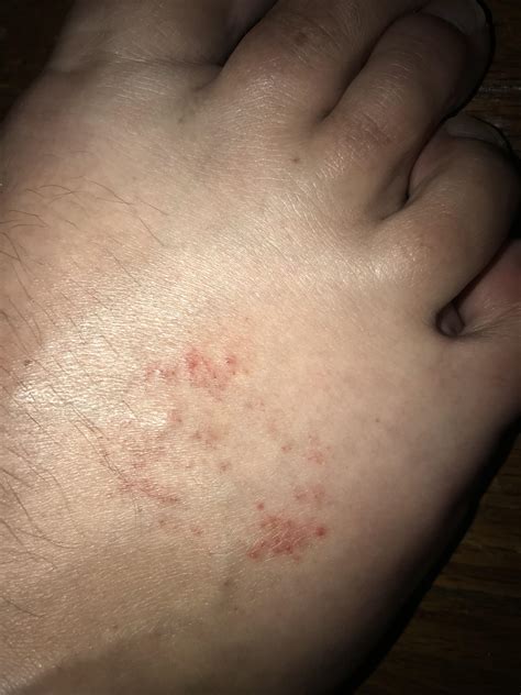 Rash On Top Of Foot Raised Small Red Bumps Not Itchy Or Painful R