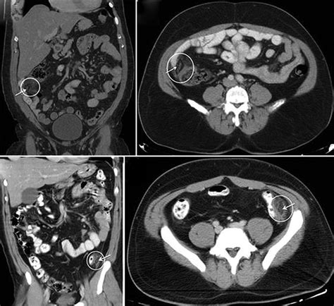Contrast Enhanced Abdominal Computed Tomography Ct Scans Of The