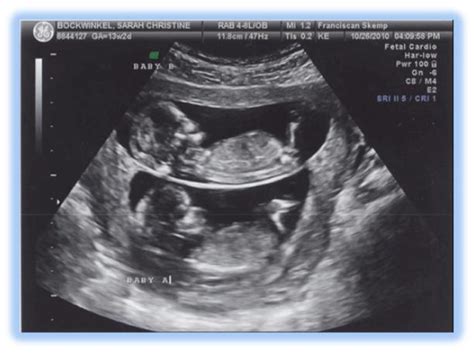 embarazo y maternidad embarazo de gemelos o mellizos como se dan y las causas