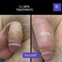 Penis Filler Injection Lpsg