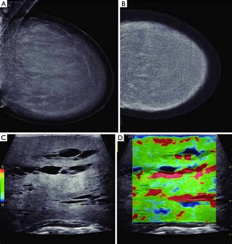 Mammography A Full Field Digital Mammography In Oblique Mid Lateral