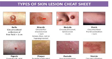 Types Of Skin Lesion Cheat Sheet Ssa Lookbook Cheat Sheets Brain Vrogue
