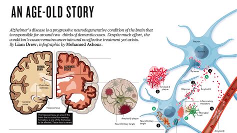 Alzheimer S Disease An Age Old Story Of Dementia