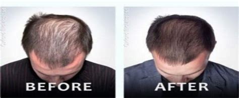 Local anesthesia can be used to numb the area so a patient who has strong hair loss genetics and is not taking any medications will need more frequent exosomes therapy. Before & After | Old Bridge, NJ | PRP Hair Loss Treatment ...
