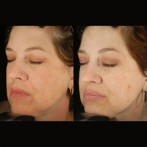 Chemical Peel Treatment Cosmetic Courses