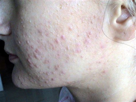 Diseases Of The Sebaceous Glands Acne Comedonal Picture Hellenic