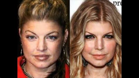 Stars Before After Plastic Surgery