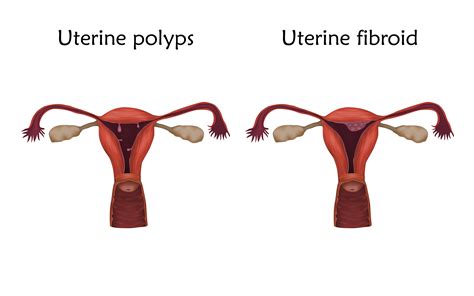 Endometrial Ablation A Popular Solution To Abnormal Bleeding For Select Patients Women S