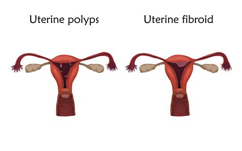 Endometrial Ablation A Popular Solution To Abnormal Bleeding For