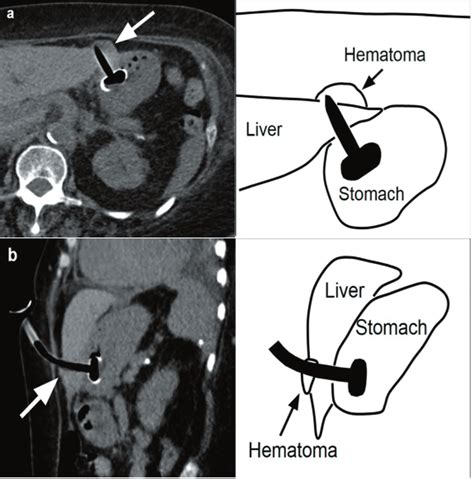 Axial Ct A Showing The Percutaneous Gastrostomy Tube Traversing The