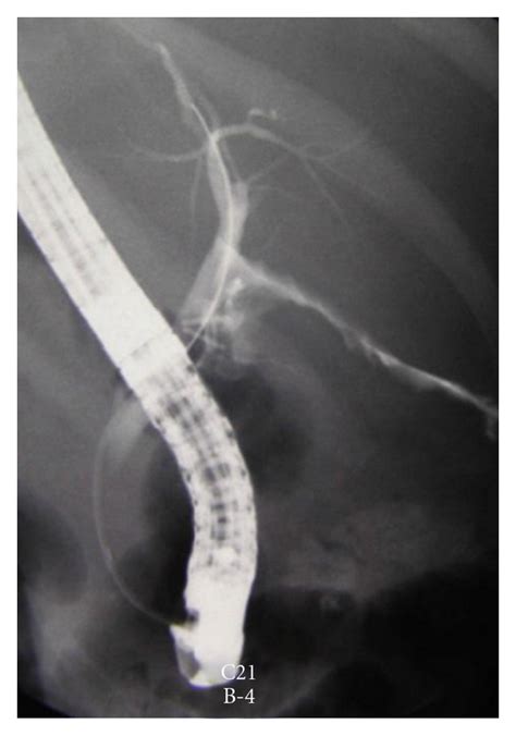 Ercp Showing Small Cbd Leak Managed Effectively By Sphincterotomy