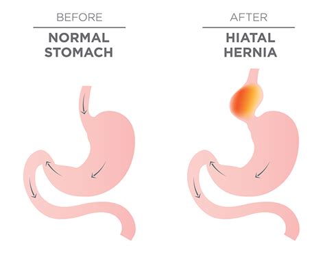 What To Know About Hiatal Hernias University Health News