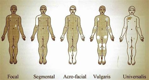 White Patches On Skin Vitiligo In 2020 Vitiligo Treatment Vitiligo
