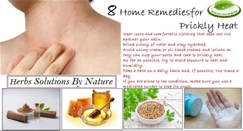 8 Home Remedies For Prickly Heat That Work Rapidly Herbs Solutions By