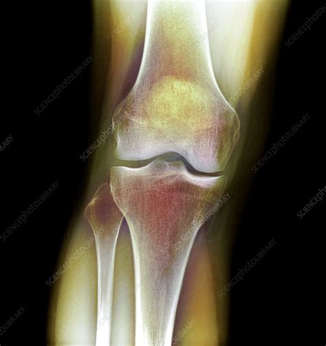 Normal Knee X Ray Stock Image F0033636 Science Photo Library