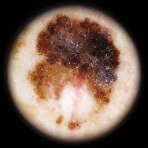 A Typical Superficial Spreading Melanoma Dermoscopically Displaying A