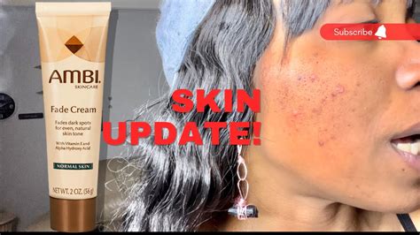 Ambi Fade Cream Severe Acne And Scarring Before And After Youtube