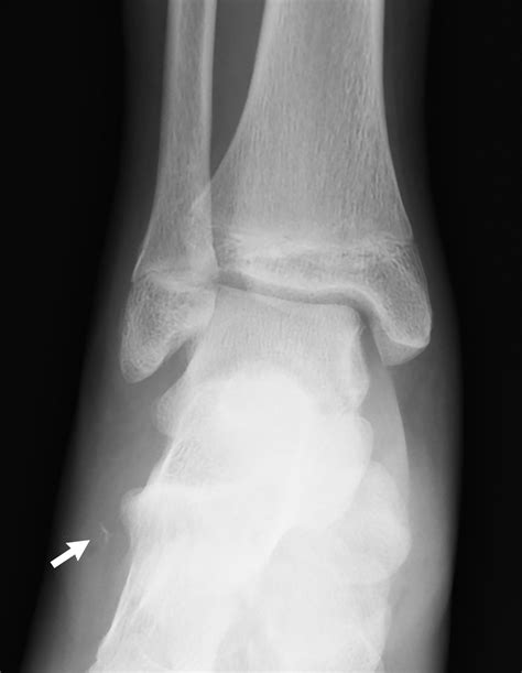 My Achin Feet Talus Fracture Radiology Key