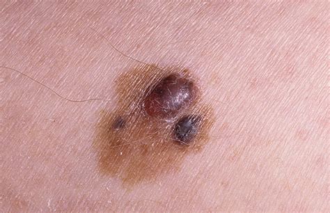 Stage 1 Melanoma Pictures 54 Photos And Images