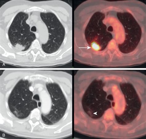 Lung On FDG PET CT Radiology Key