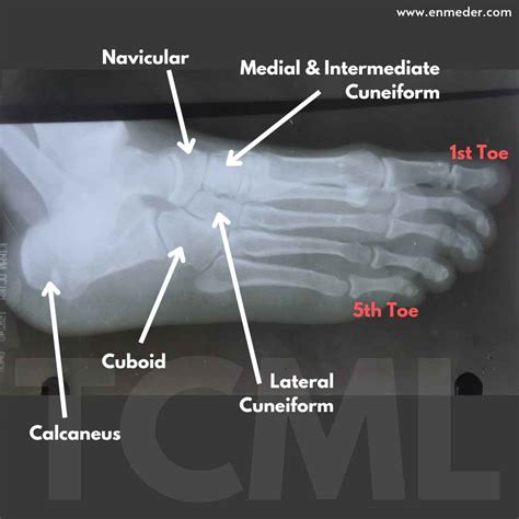 Tarsal Bone Tcml The Charsi Of Medical Literature