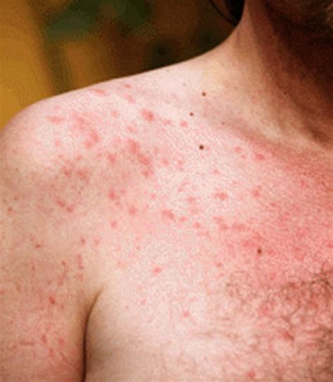 Sun Poisoning Pictures Symptoms Causes Treatment