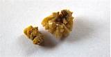 Pictures of Holistic Cure Kidney Stones