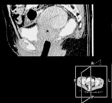 Sagittal Reformatted Ct Image Of The Pelvis Shows The Cervical