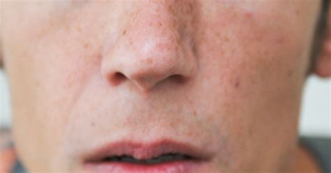 How To Reduce Redness Around Nose Livestrongcom