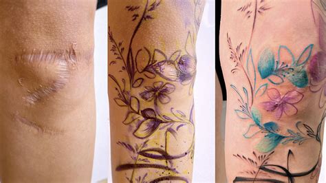 Details More Than 67 Surgery Scar Tattoo Latest Vn