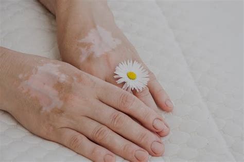 White Spots On Skin Here Are 9 Effective Home Remedies To Get Rid Of Them