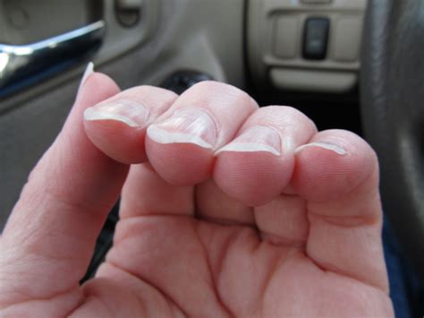 Bjhsblog Nail Health Problems Fingernail Health Ehlers Danlos