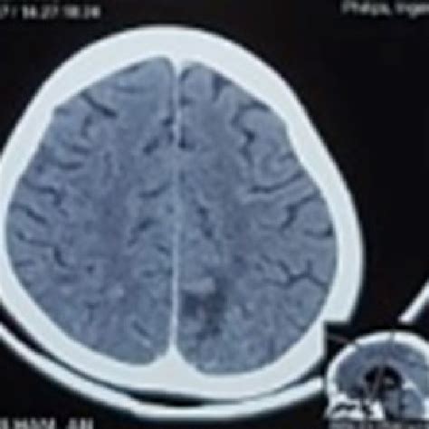 Ct Scan Brain Shows Hyper Density In Left Parietal Lobe With Hypodense