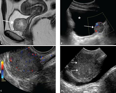transvaginal ultrasound‐guided biopsy of deep pelvic masses plett 2016 journal of